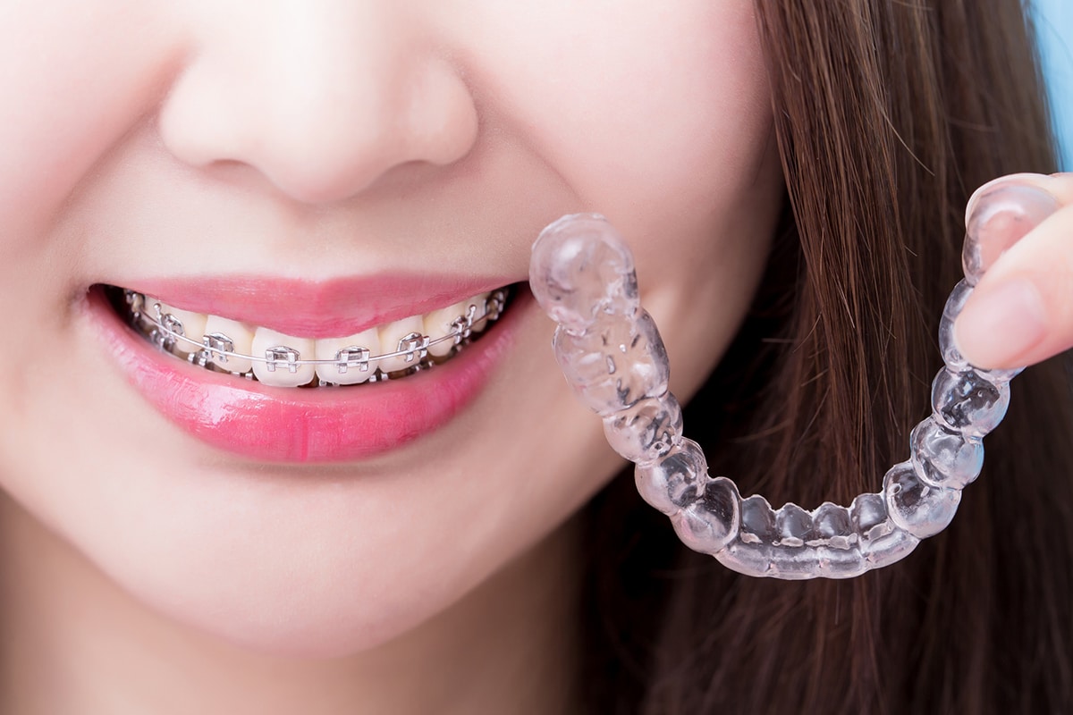 Damon vs Traditional Braces: What Delmar Patients Should Know