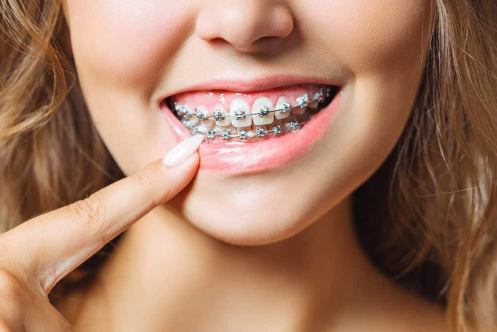 Can You Get Braces Just on Your Bottom Teeth?