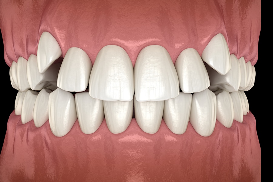 Crowded Teeth Photo
