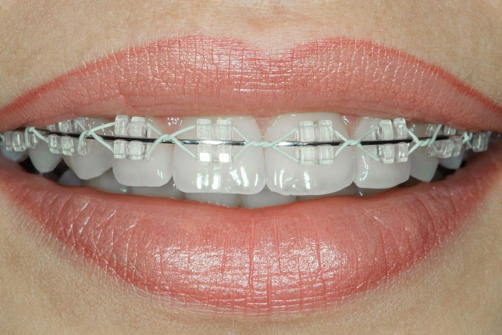 Do You Need To See An Orthodontist For Clear Aligners Blog 1024x683