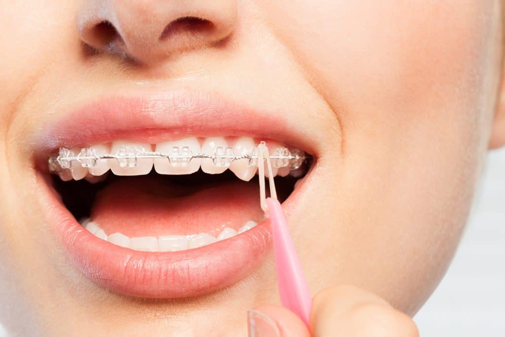 How to Floss While You Have Braces | Embrace Orthodontics