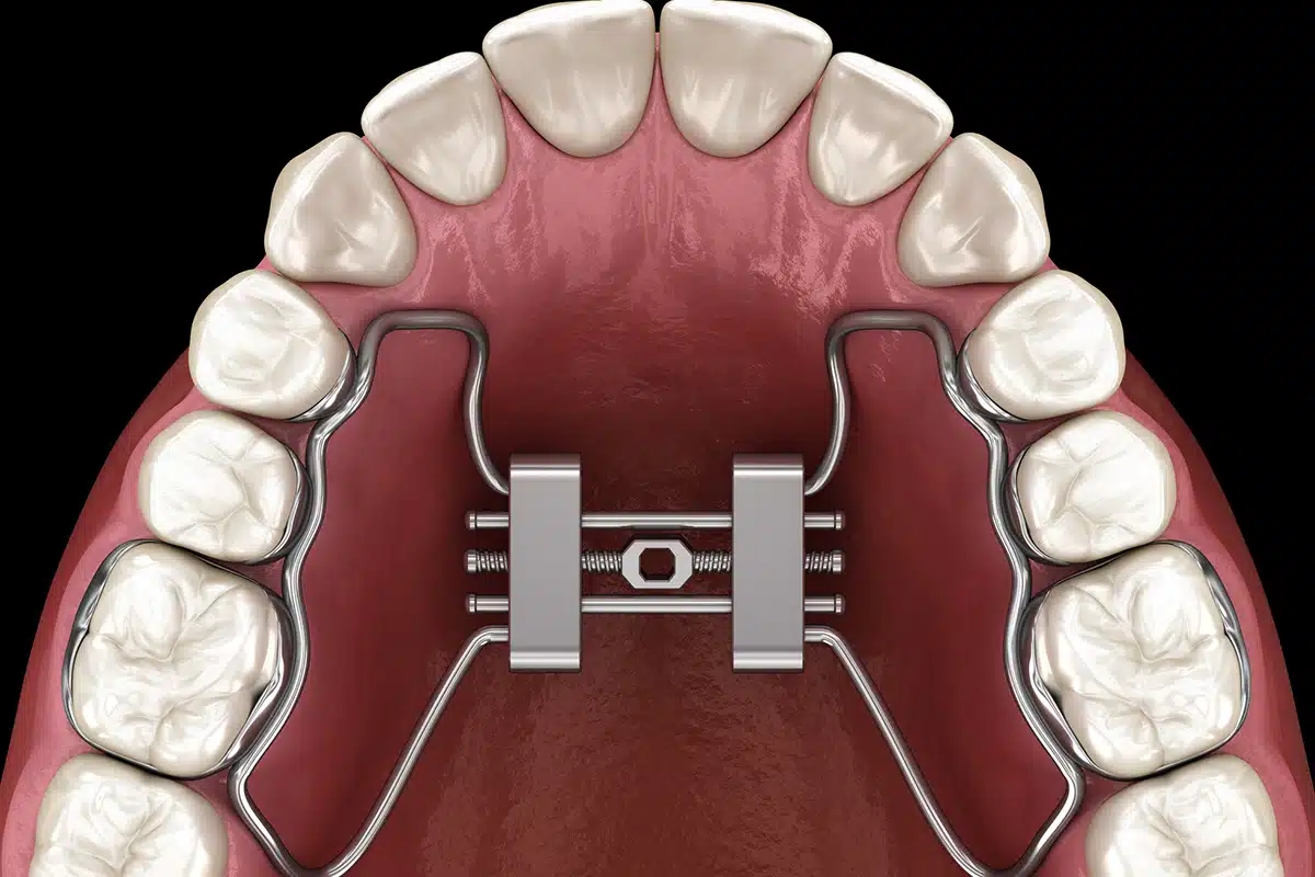 Marpe vs traditional palatal expanders which is better for narrow palates blog