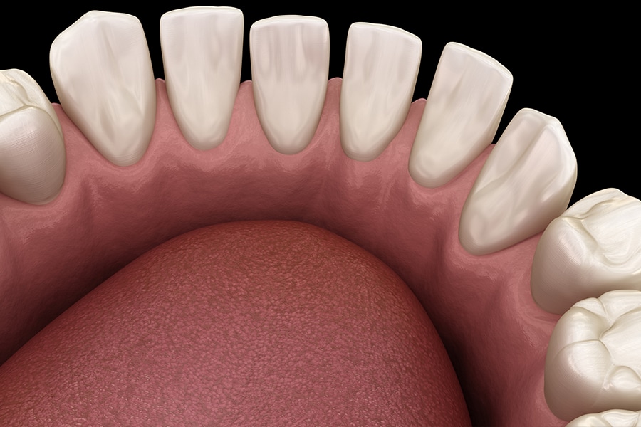 Spacing of Teeth Photo